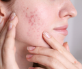 Acne IV